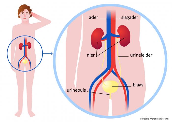 Nierschade door nierbekkenontsteking